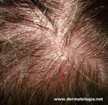 SCALP AND HAIR THERAPY